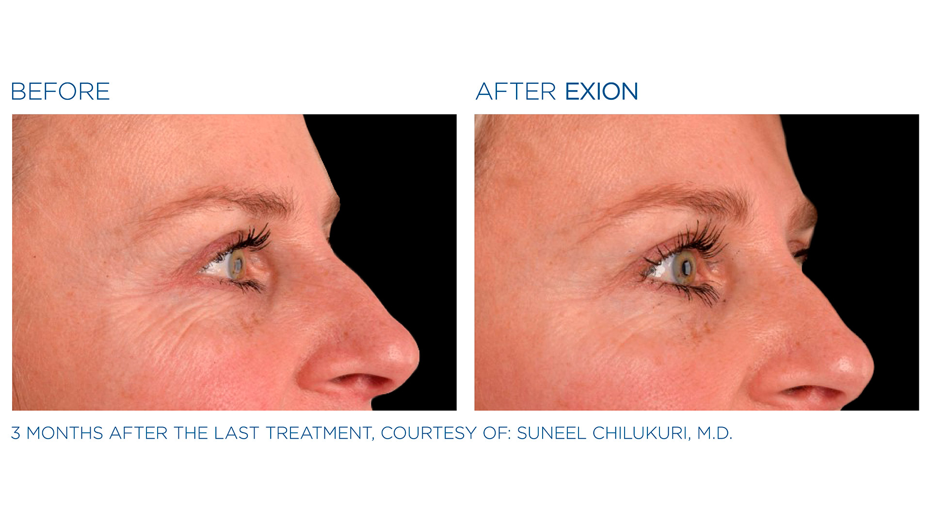 Exion_01